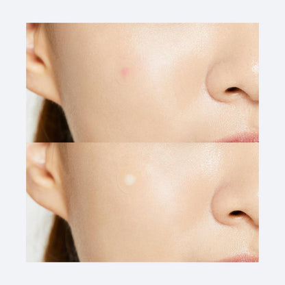 Adelyne's Boutique & Gifts Acne Pimple Master Patch applied on skin to reduce blemishes and promote clear complexion