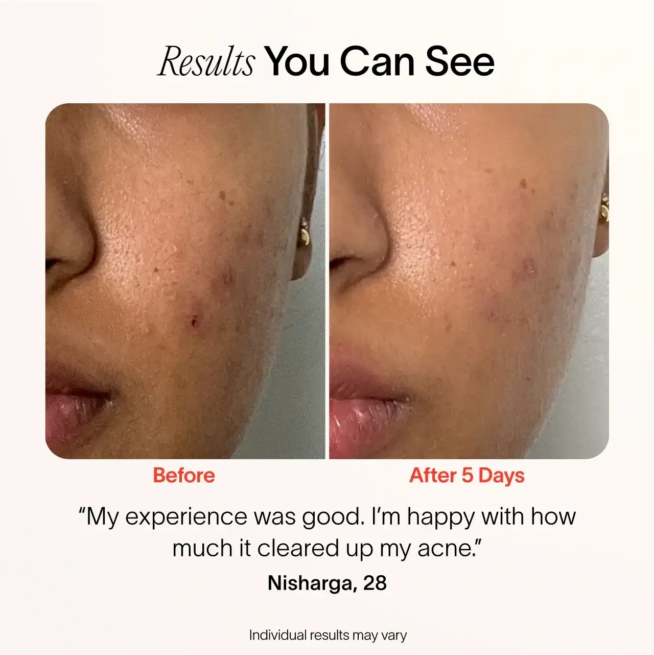 Solawave Bye Acne pimple spot treatment in periwinkle, a skincare tool for quick acne spot relief with a sleek design.