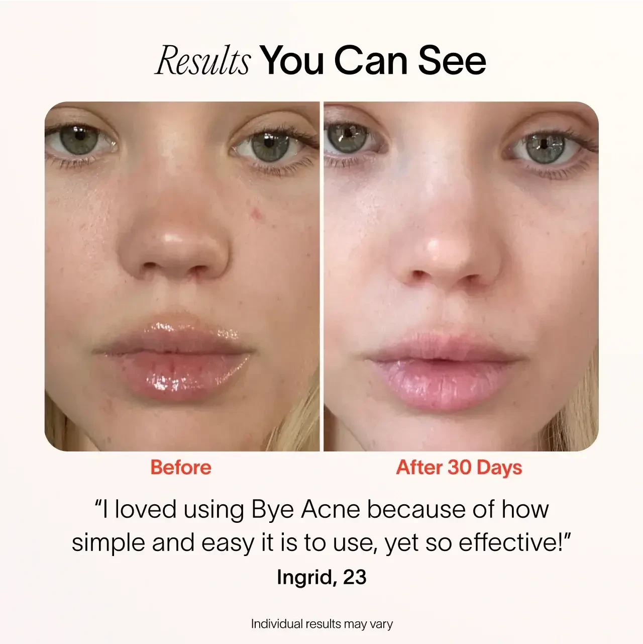 Solawave Bye Acne 3-Minute Pimple Spot Treatment skincare tool in periwinkle, designed to target pimples quickly and effectively.