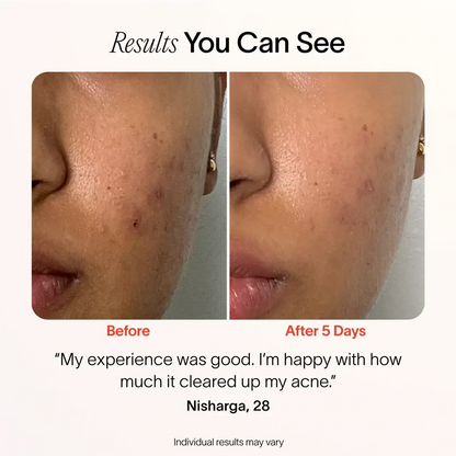 Solawave Bye Acne 3-Minute Pimple Spot Treatment skincare tool in periwinkle color, designed for quick blemish relief.