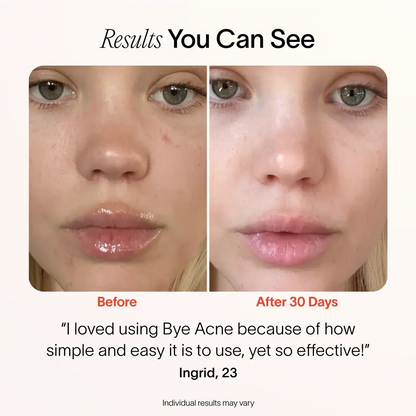 Solawave Bye Acne 3-Minute Pimple Spot Treatment skincare tool in periwinkle color, designed for quick blemish relief.